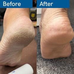 20% Urea Foot Roll On - 50 ml
